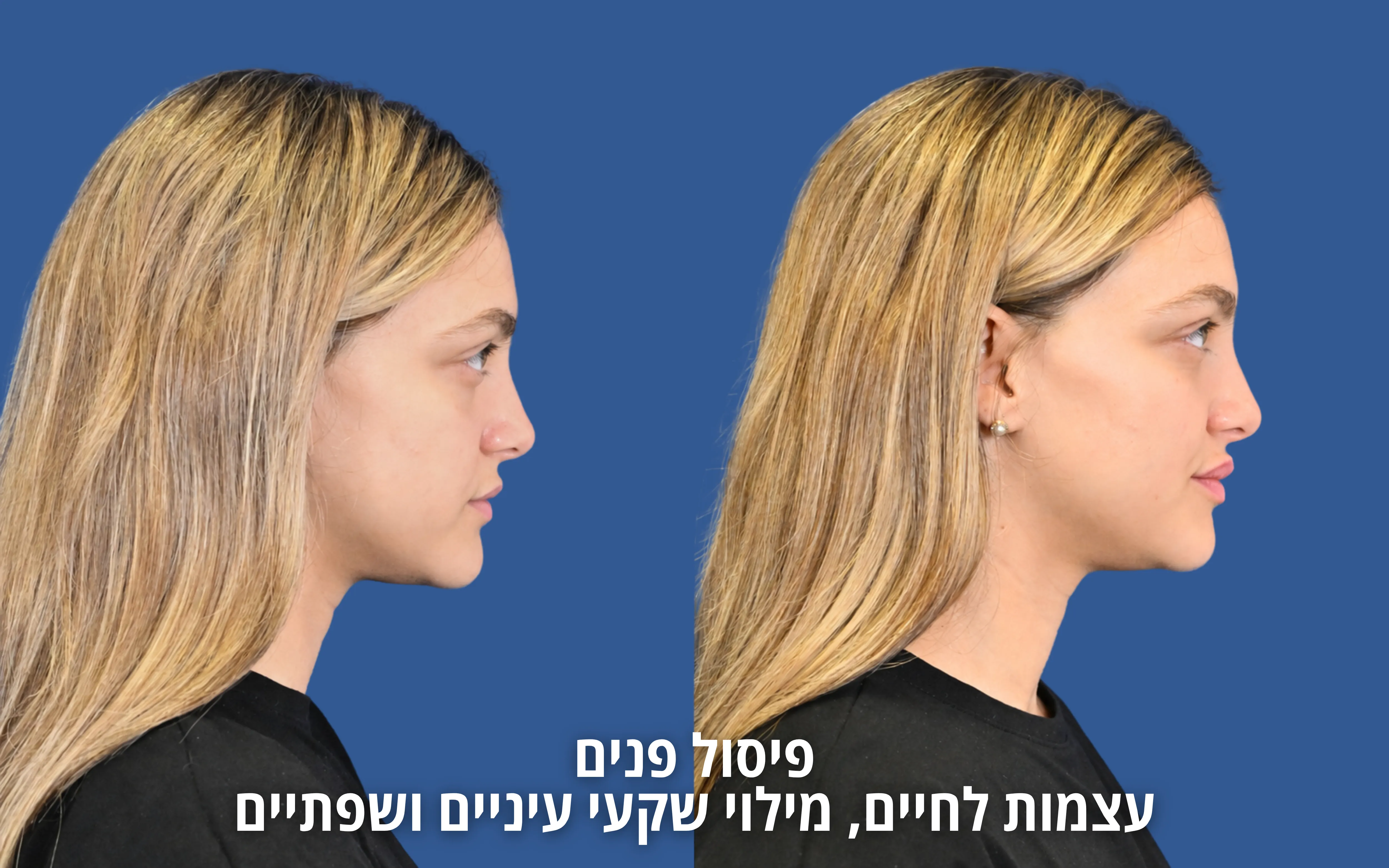 הזרקות ואסתטיקה רפואית לפני ואחרי אצל ד״ר דוד טל