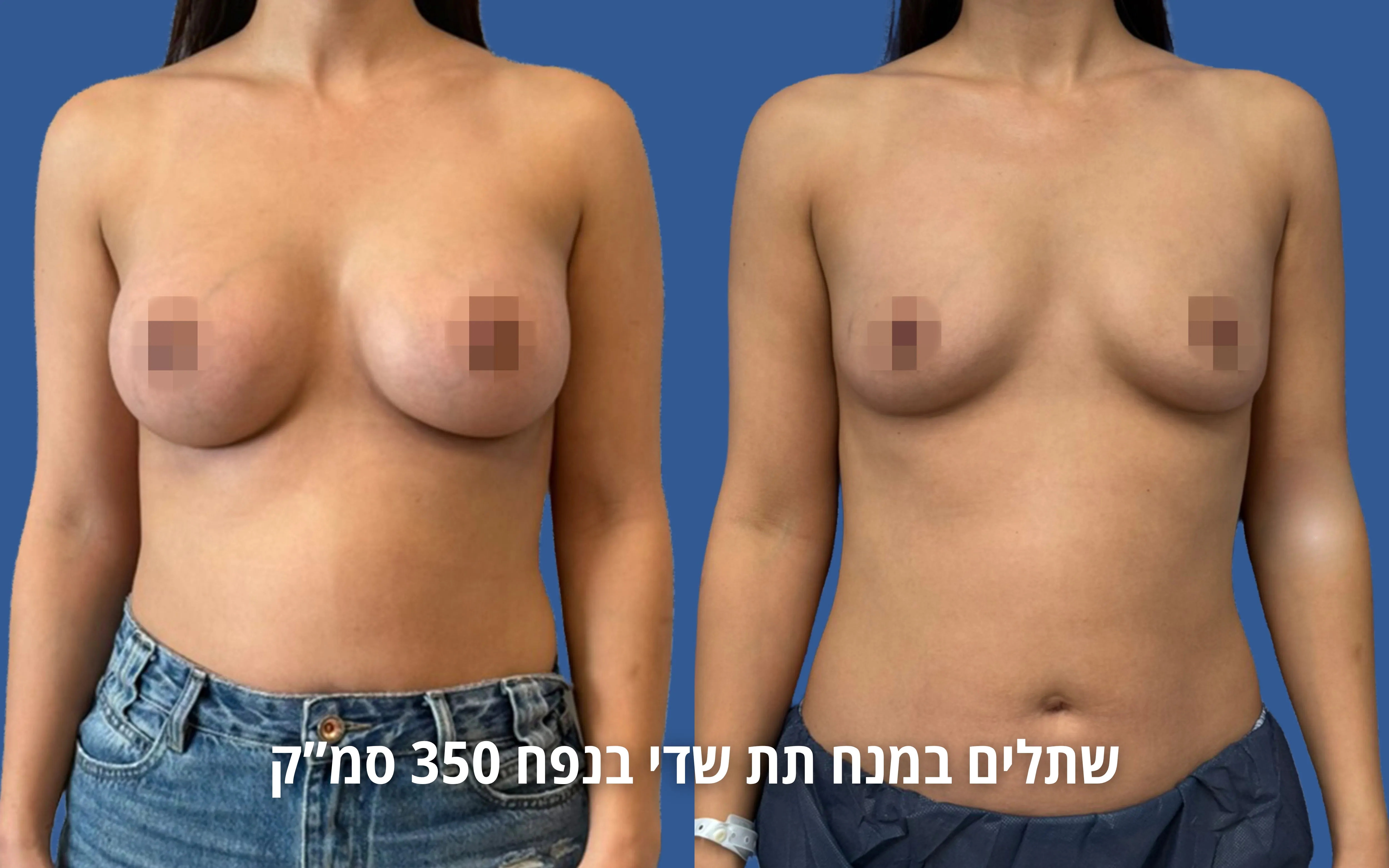 הגדלת חזה לפני ואחרי