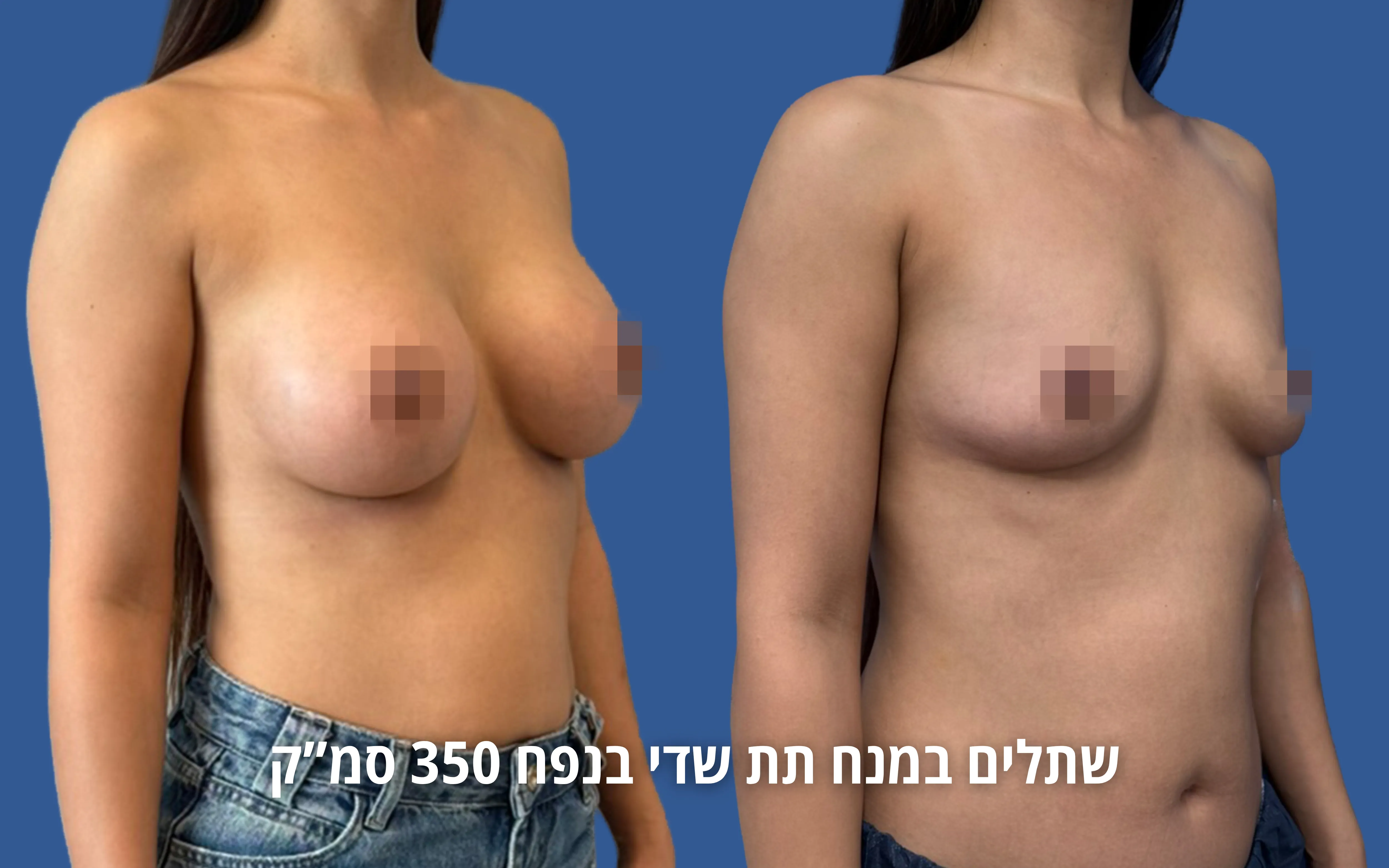 הגדלת חזה לפני ואחרי