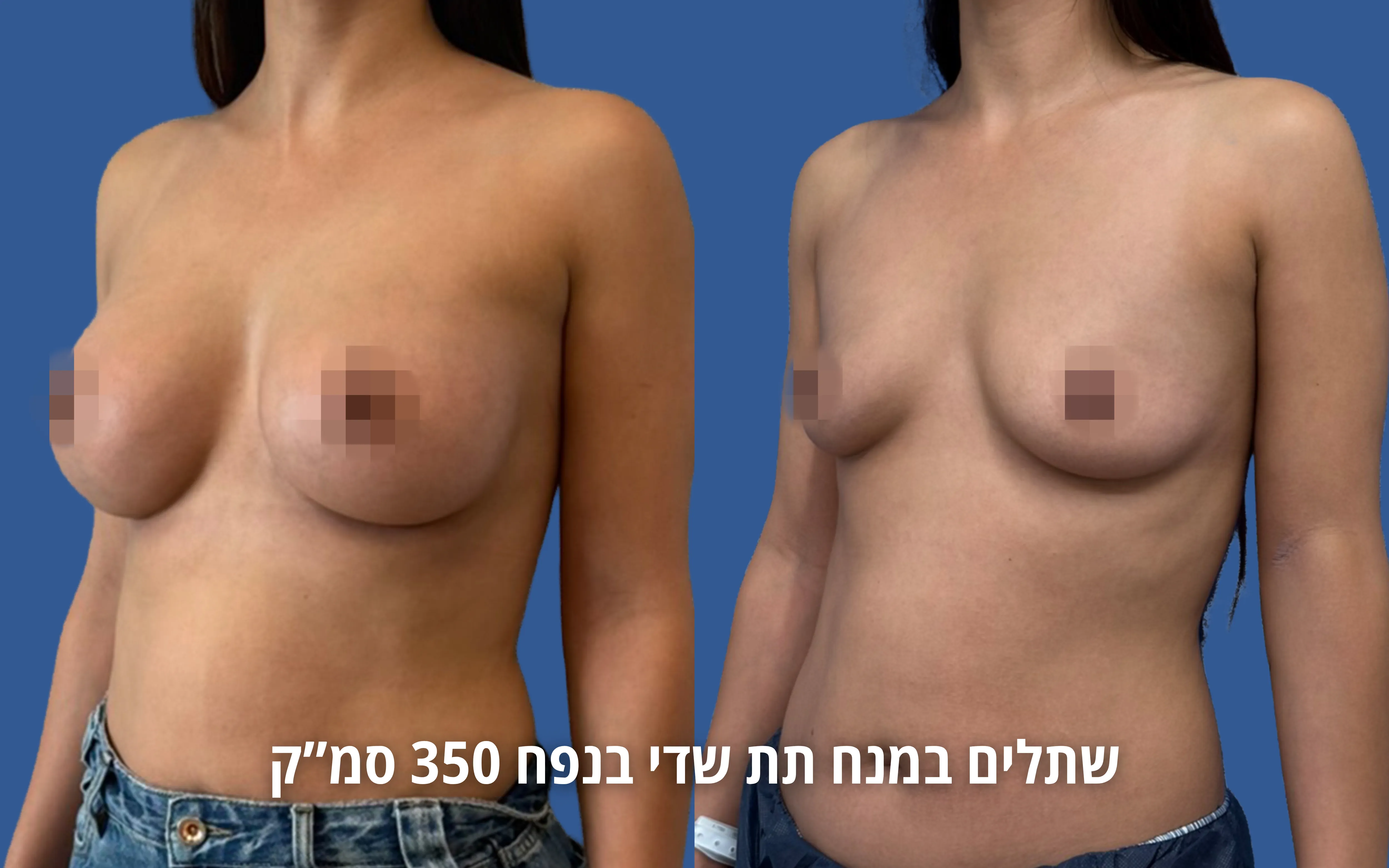 הגדלת חזה לפני ואחרי
