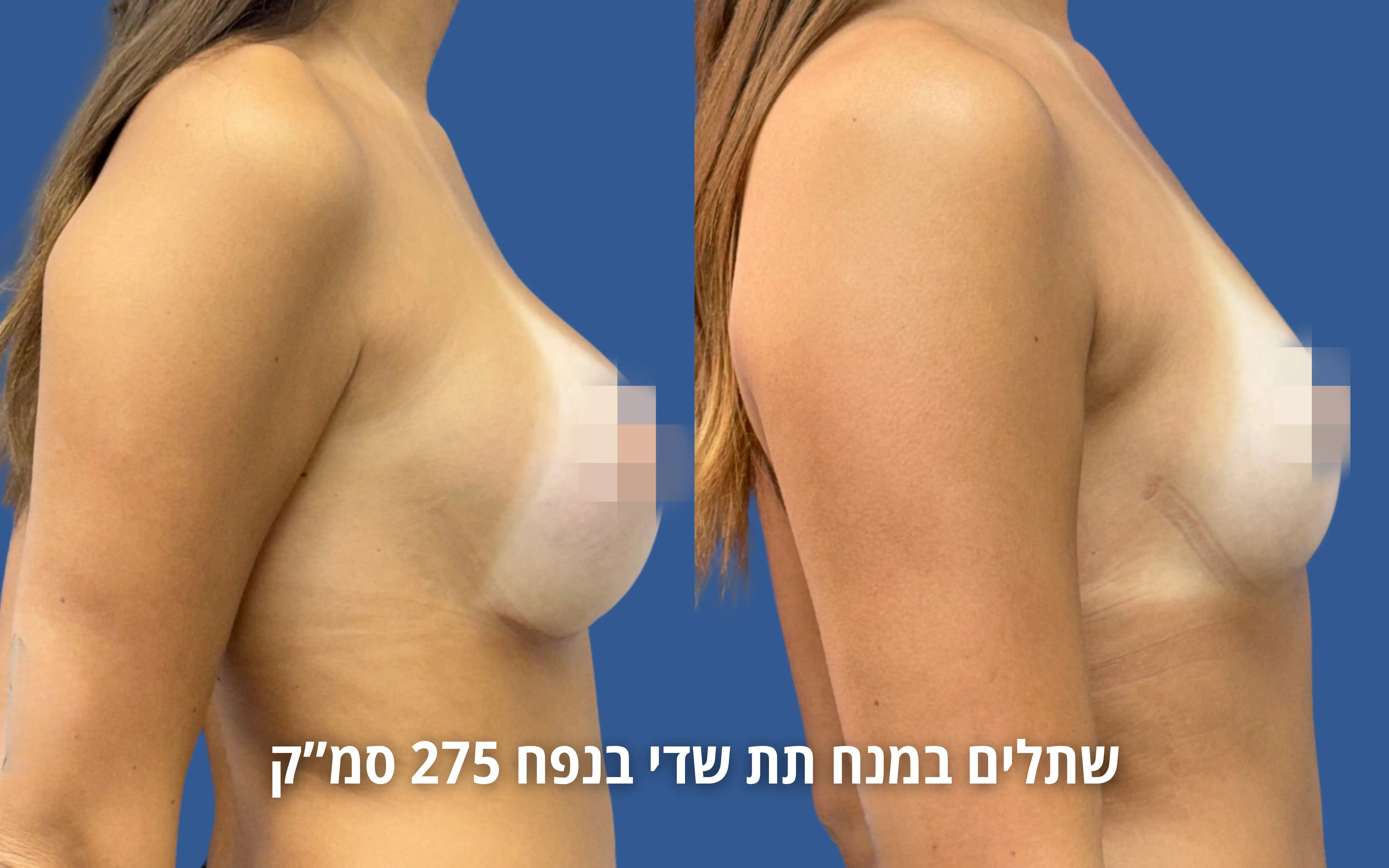 הגדלת חזה לפני ואחרי