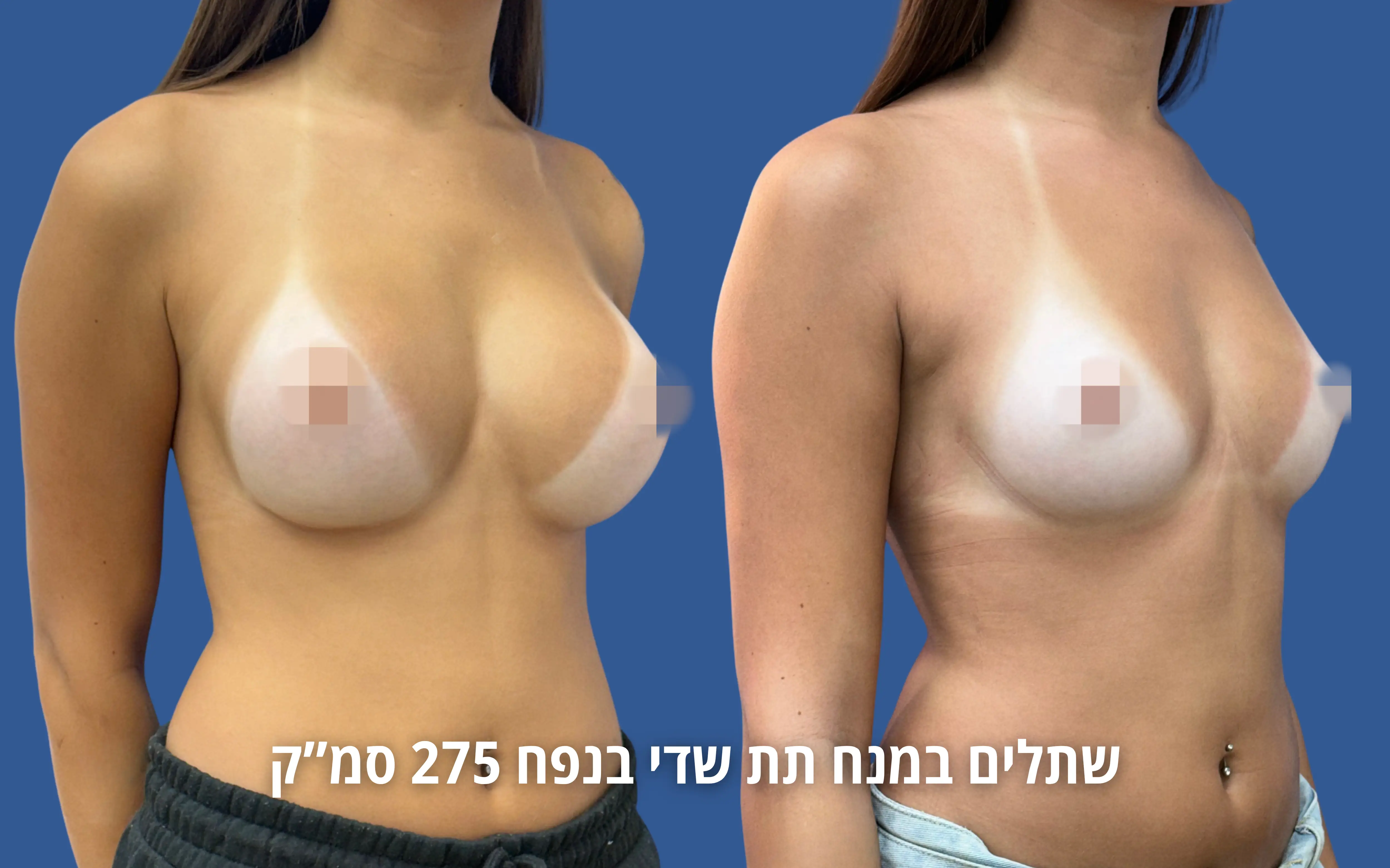 הגדלת חזה לפני ואחרי
