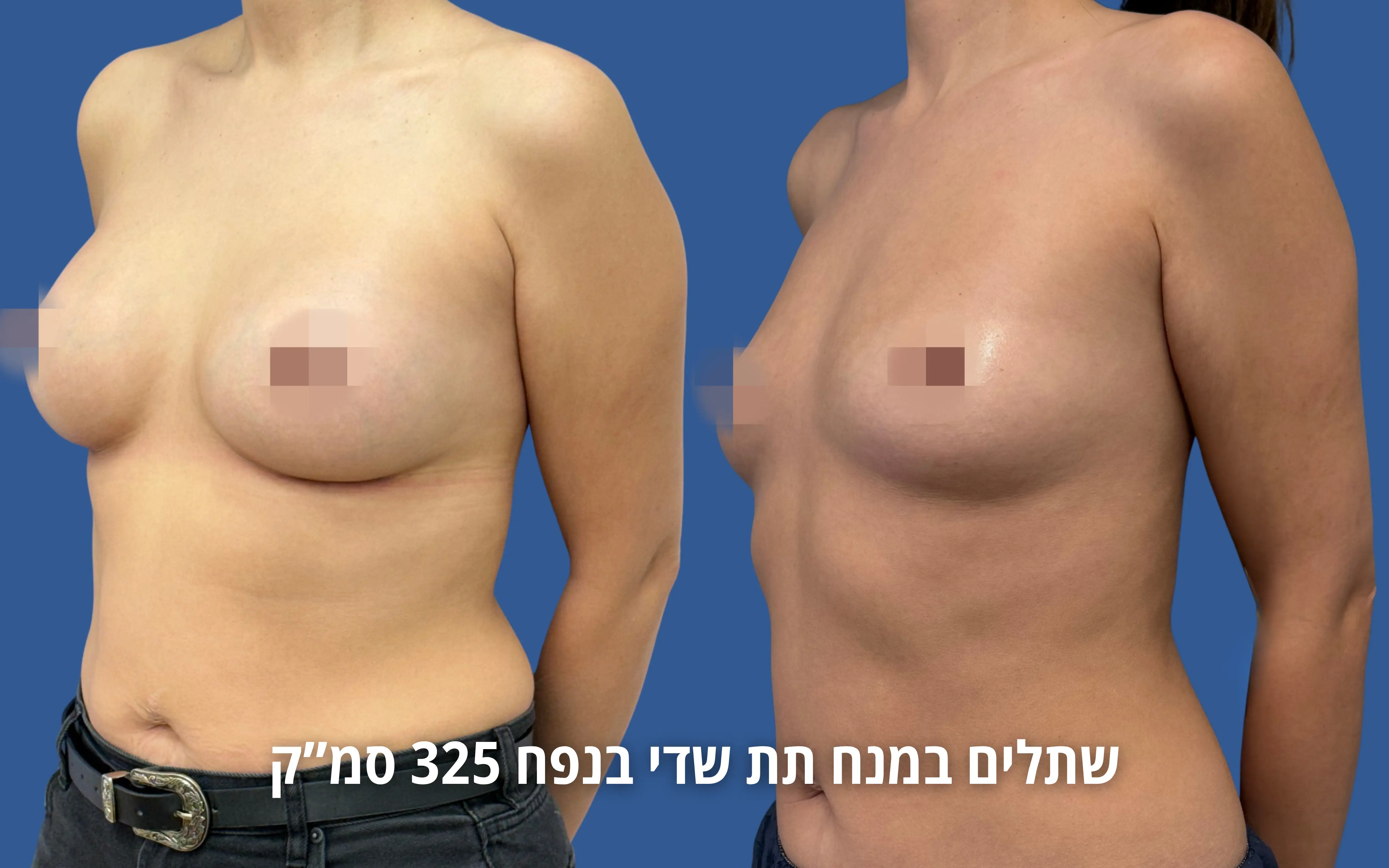 הגדלת חזה לפני ואחרי