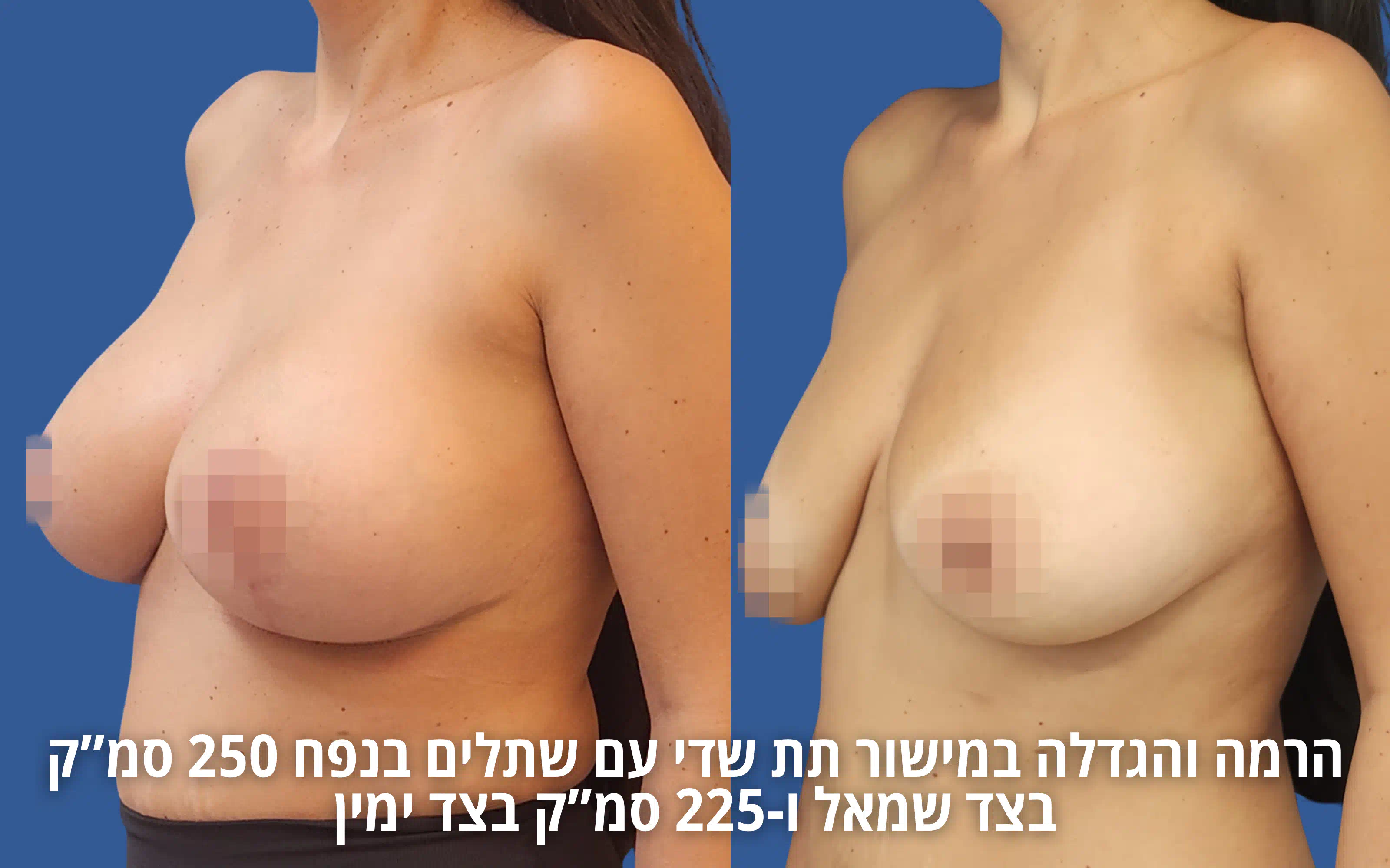 תוצאה טבעית לאחר הרמת חזה עם שתל אצל ד״ר דוד טל