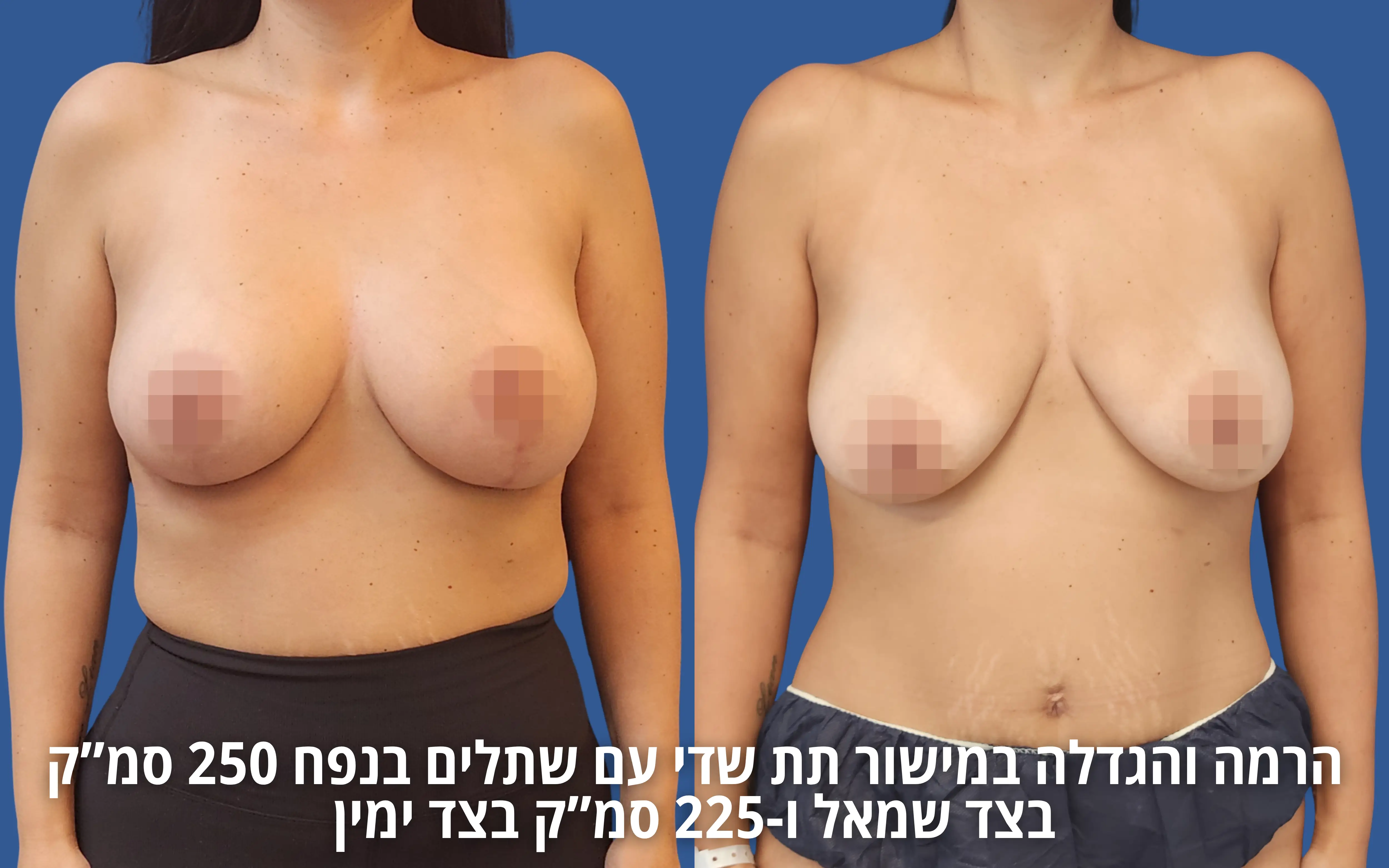 הרמת חזה עם שתל לפני ואחרי אצל ד״ר דוד טל