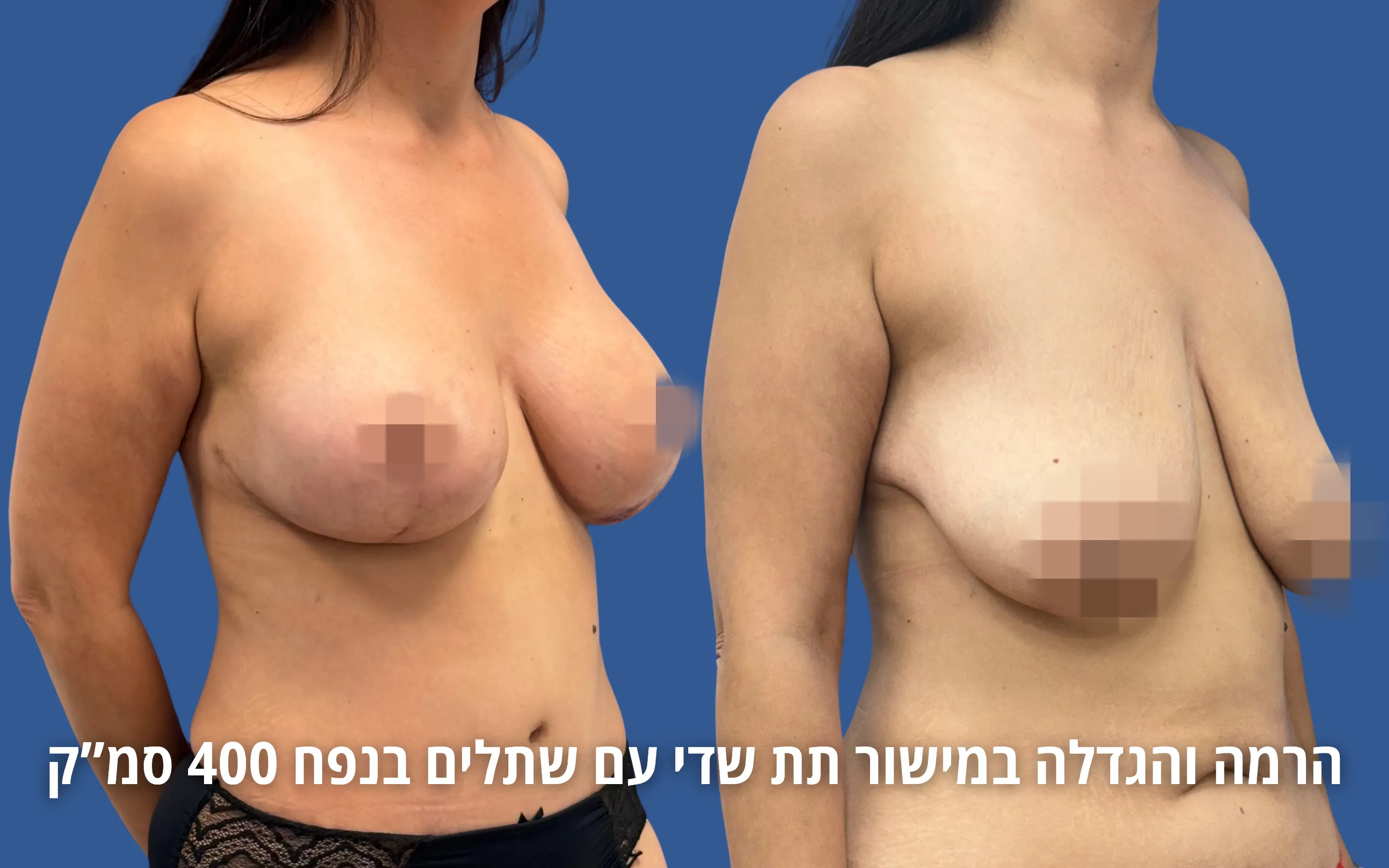 הרמת חזה עם שתל לפני ואחרי אצל ד״ר דוד טל