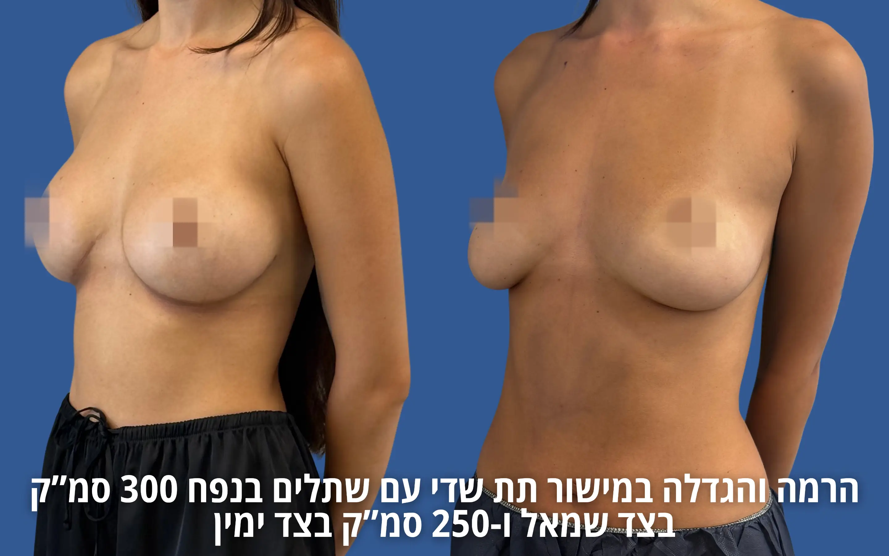 הרמת חזה עם שתל לפני ואחרי אצל ד״ר דוד טל