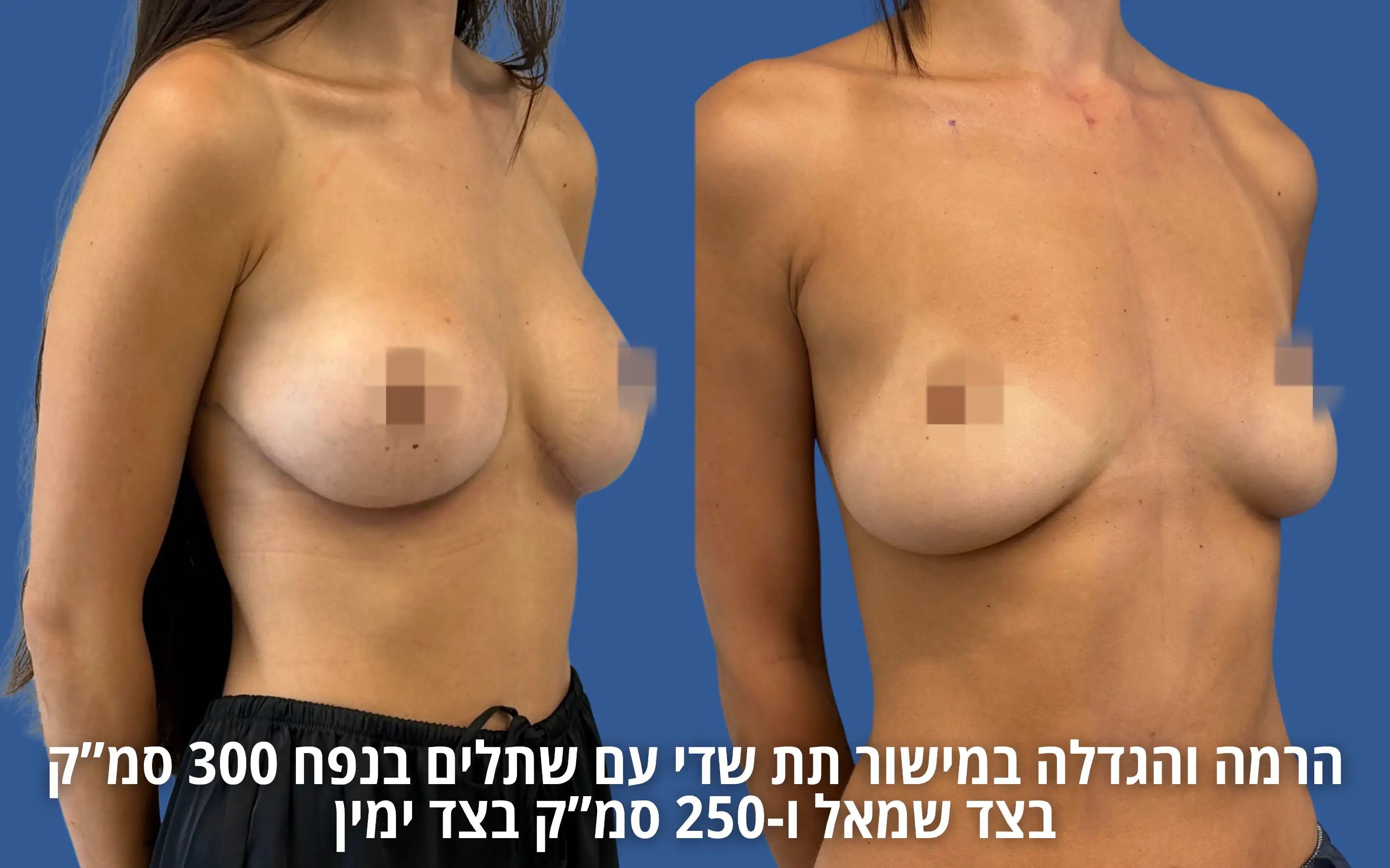 הרמת חזה עם שתל לפני ואחרי אצל ד״ר דוד טל