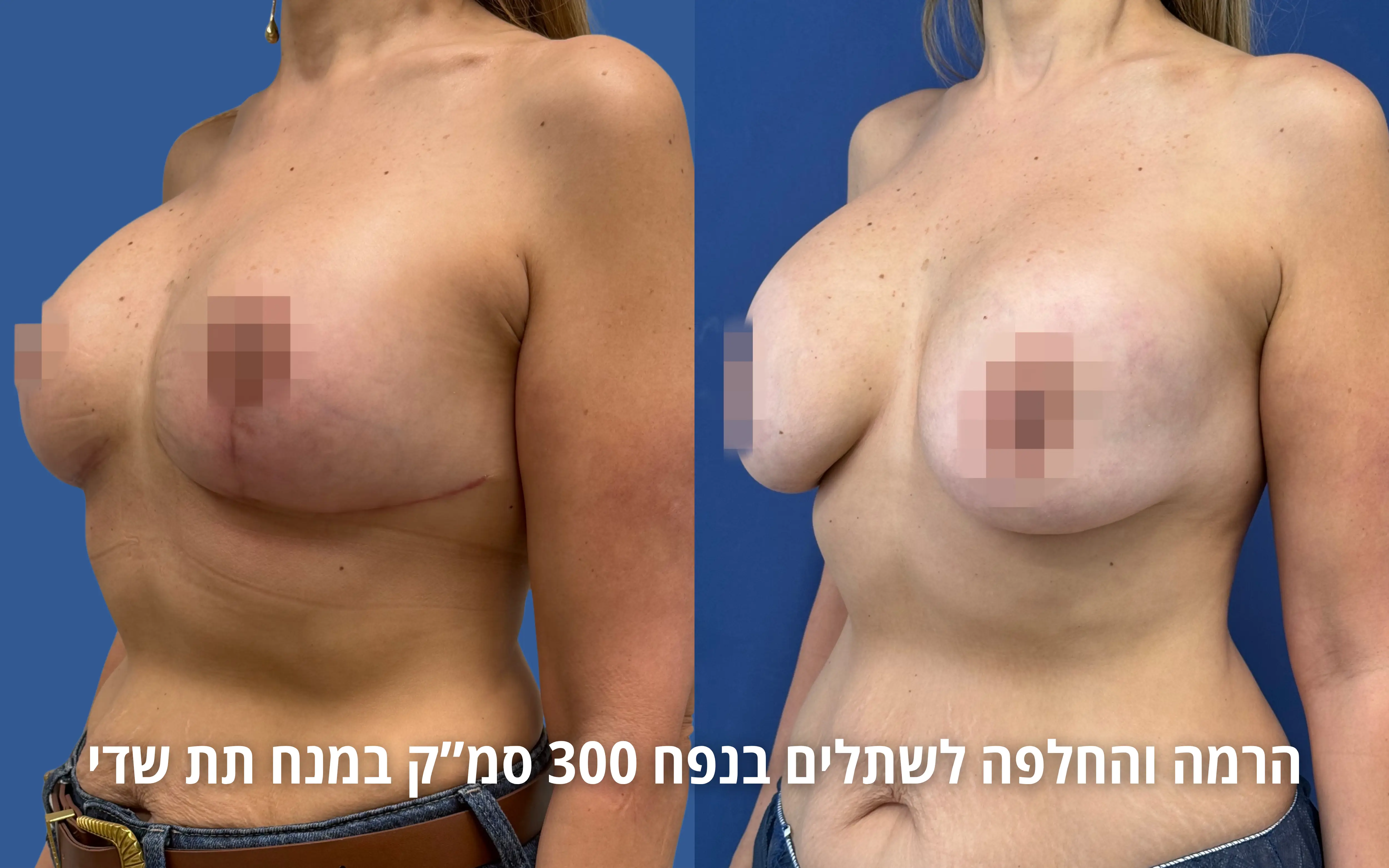 תוצאה לאחר החלפת או הוצאת שתלים אצל ד״ר דוד טל