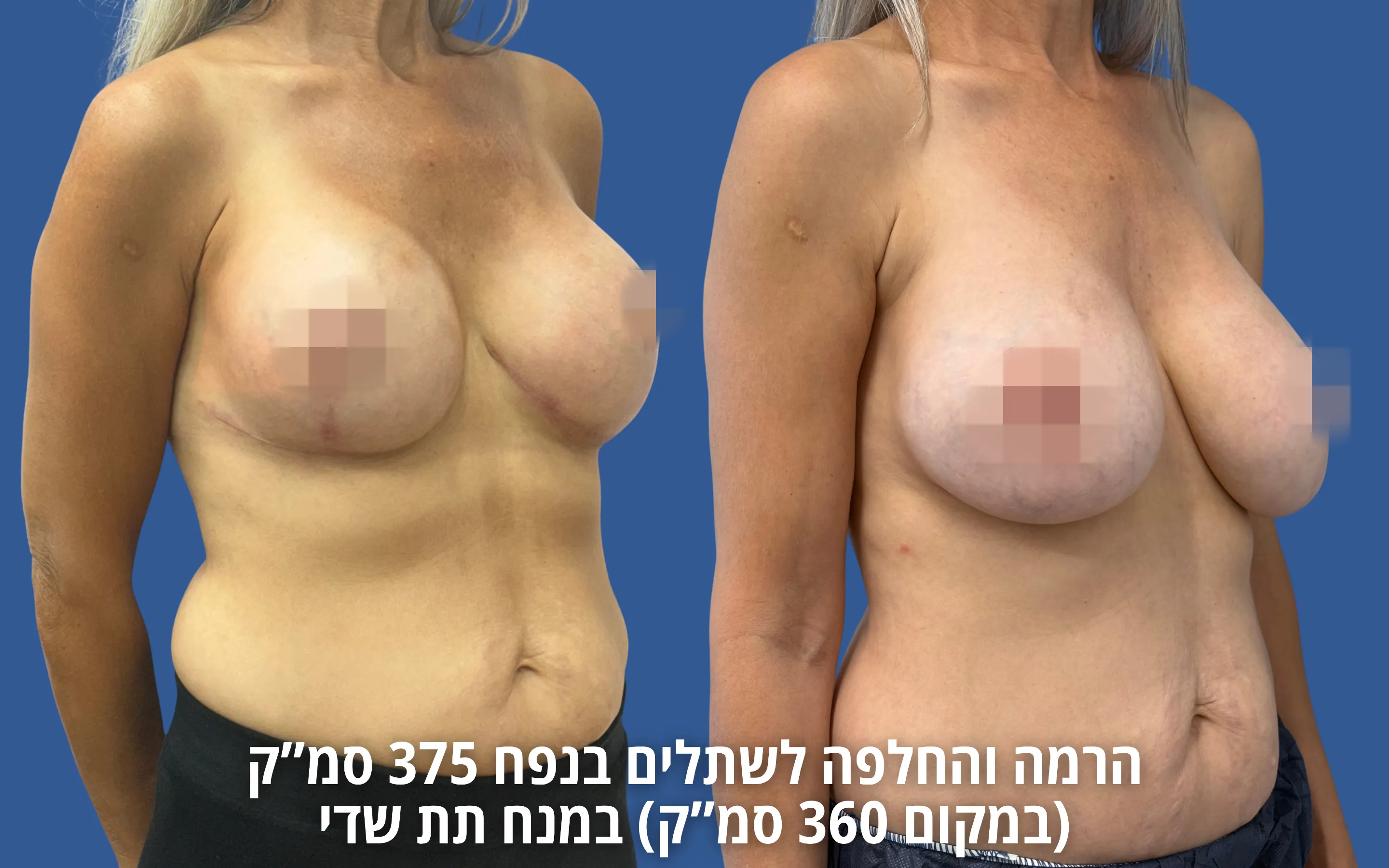 תוצאה לאחר החלפת או הוצאת שתלים אצל ד״ר דוד טל
