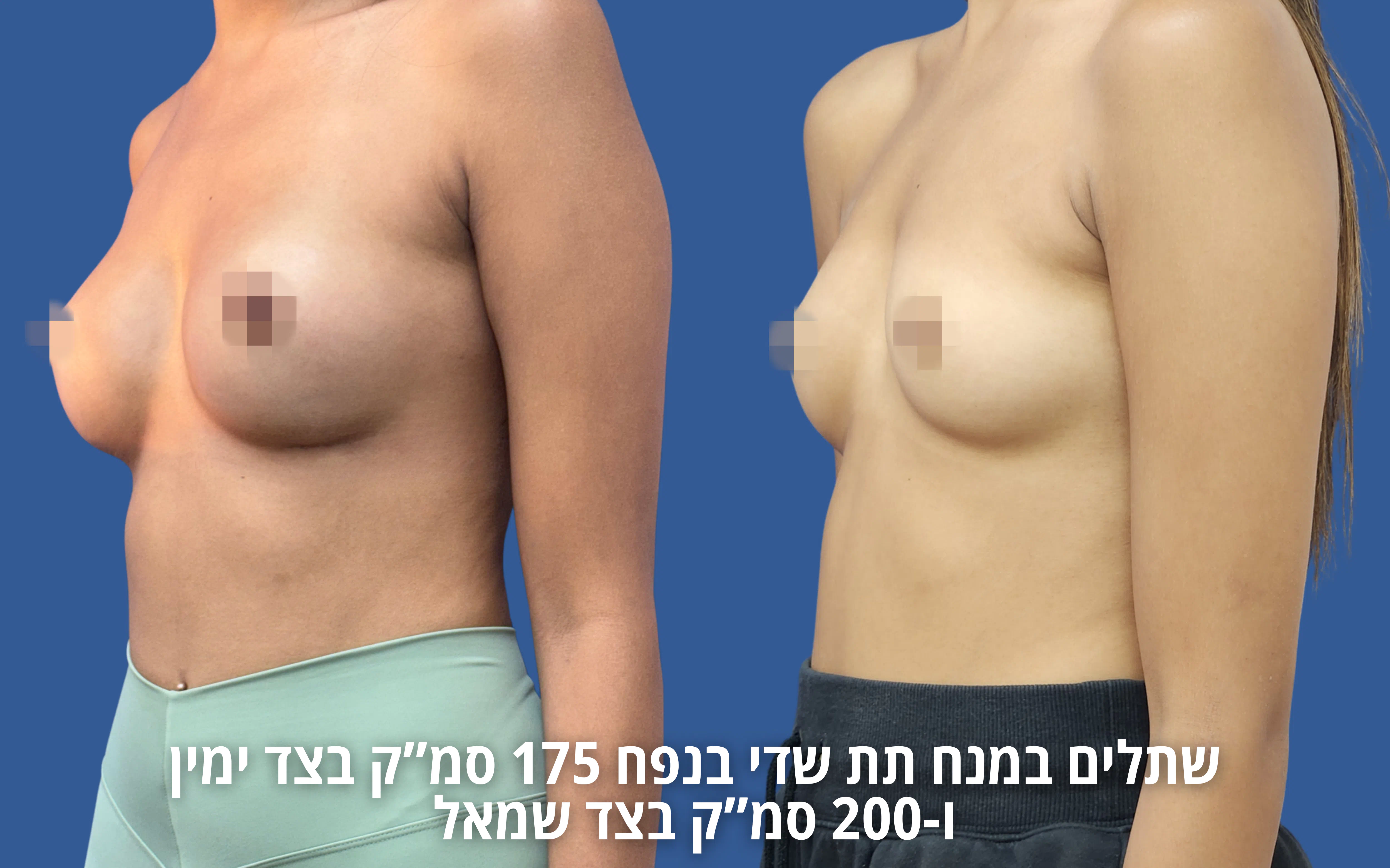 הגדלת חזה לפני ואחרי