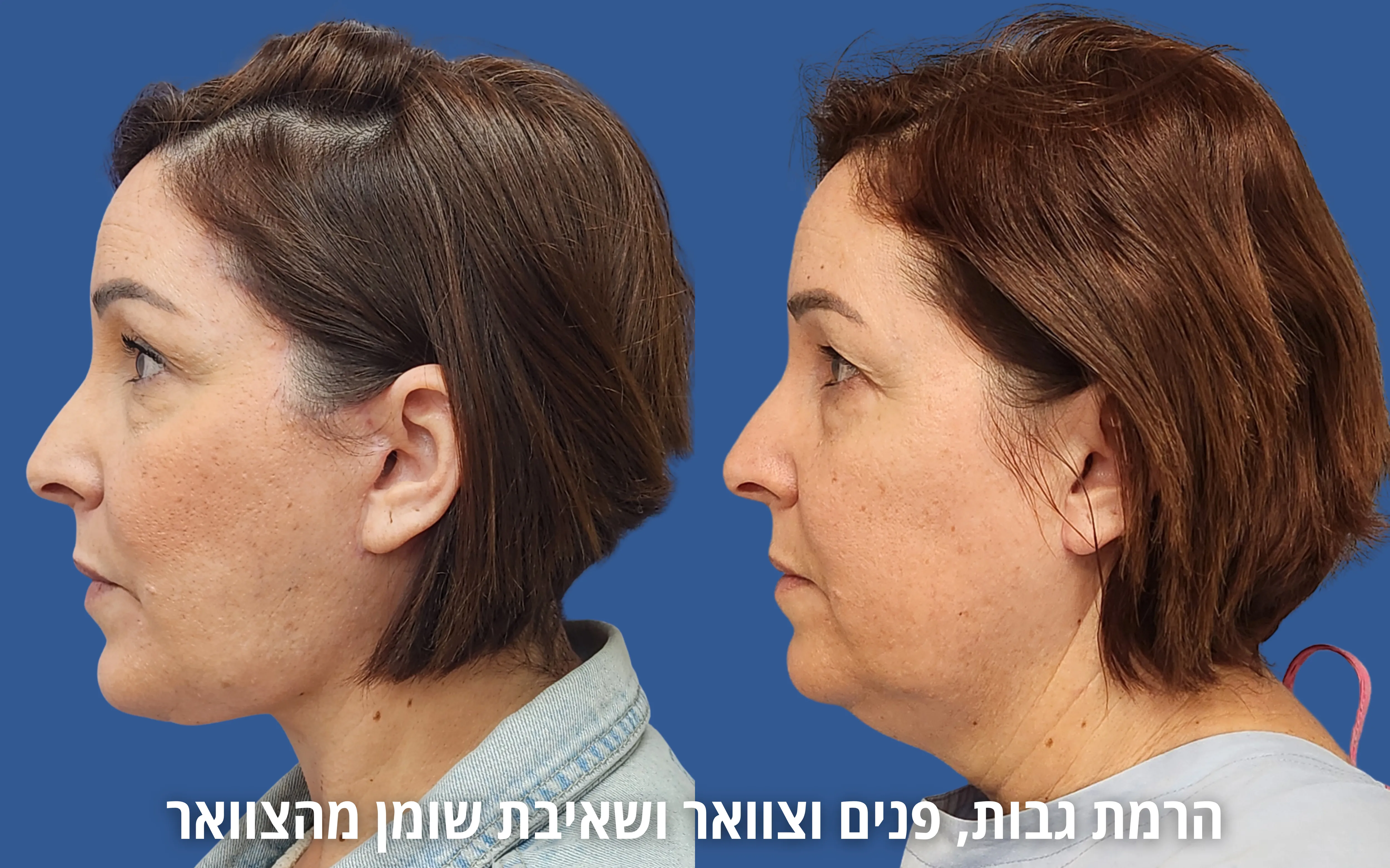 ניתוחי פנים לפני ואחרי אצל ד״ר דוד טל