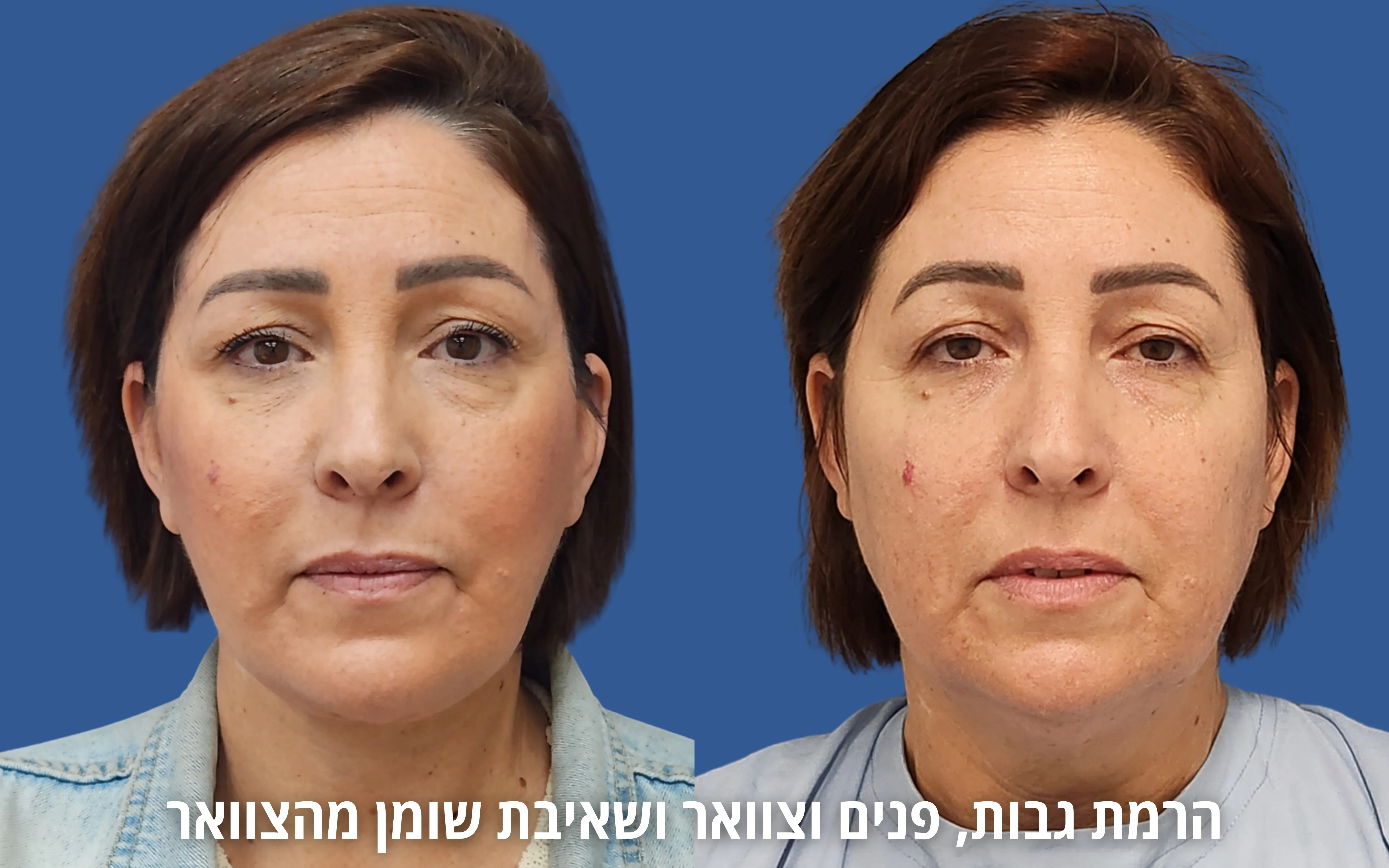 תמונת לפני ואחרי ניתוח פנים בגישה טבעית