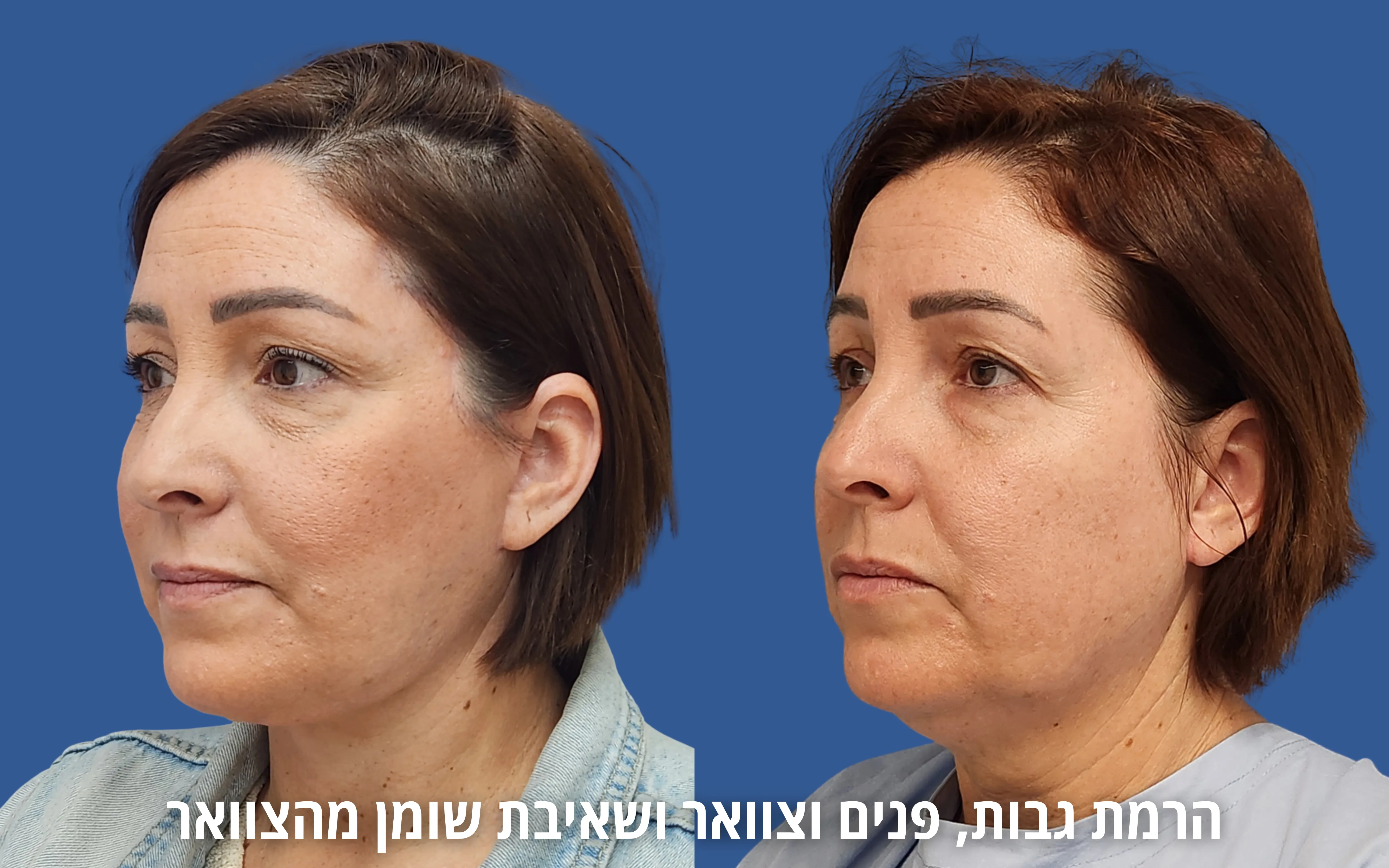 ניתוחי פנים לפני ואחרי אצל ד״ר דוד טל