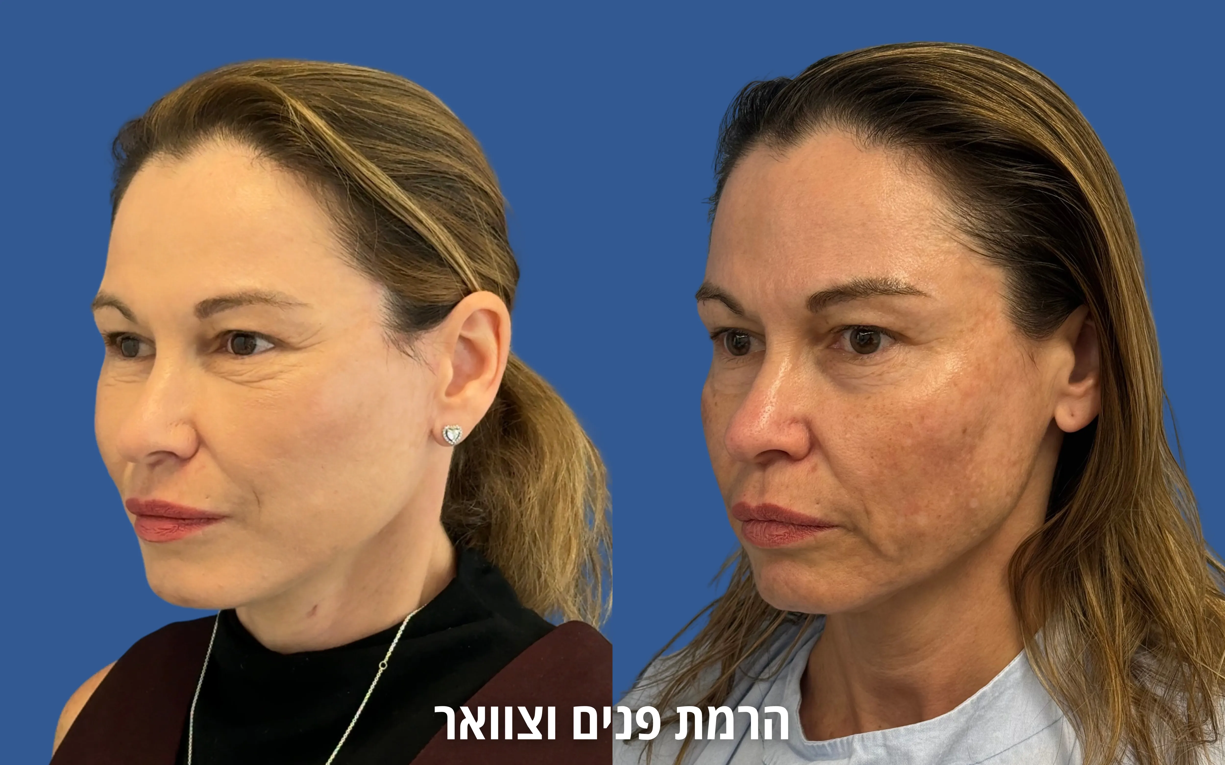 תוצאה טבעית לאחר ניתוח פנים לפני ואחרי