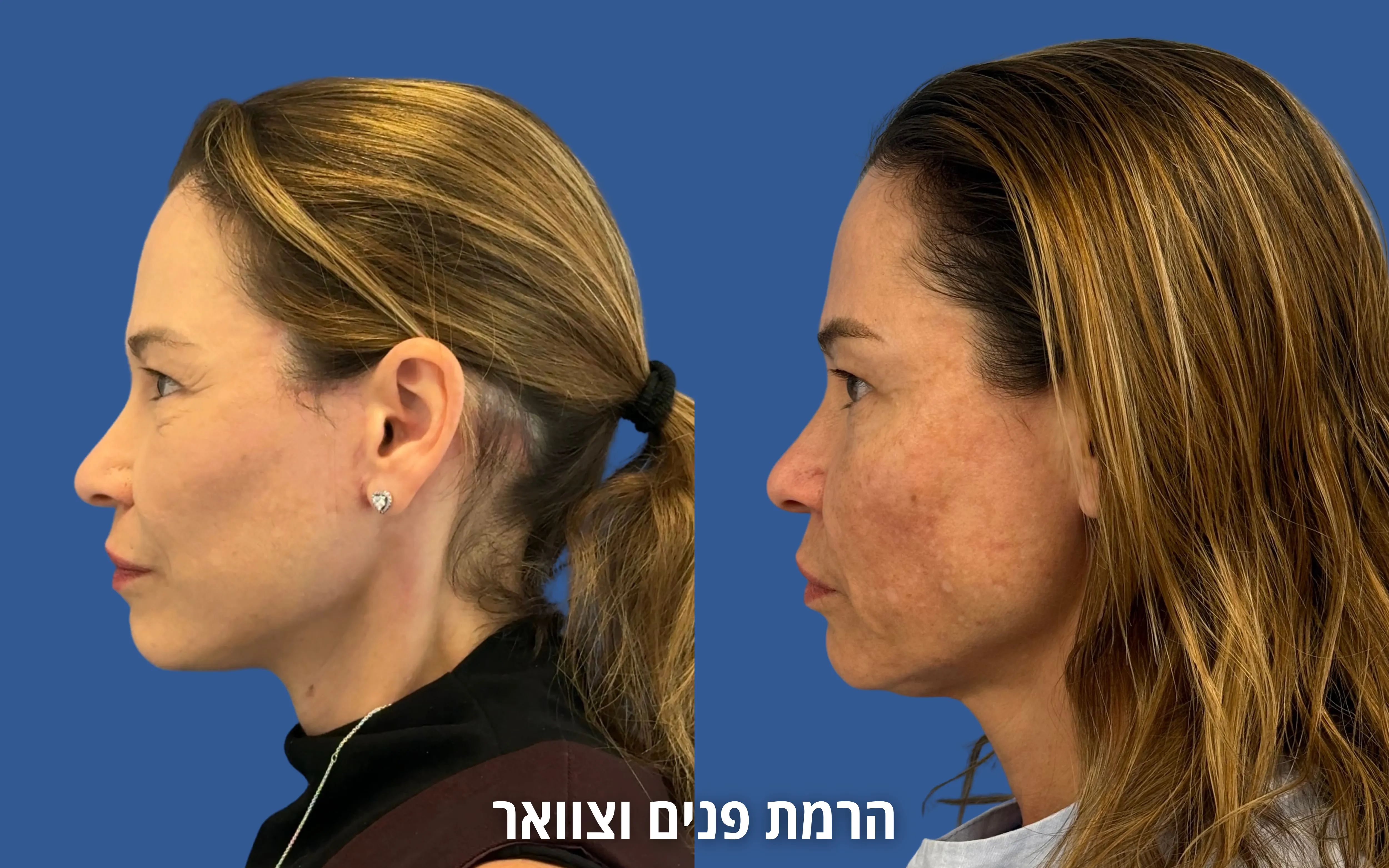 ניתוחי פנים לפני ואחרי אצל ד״ר דוד טל