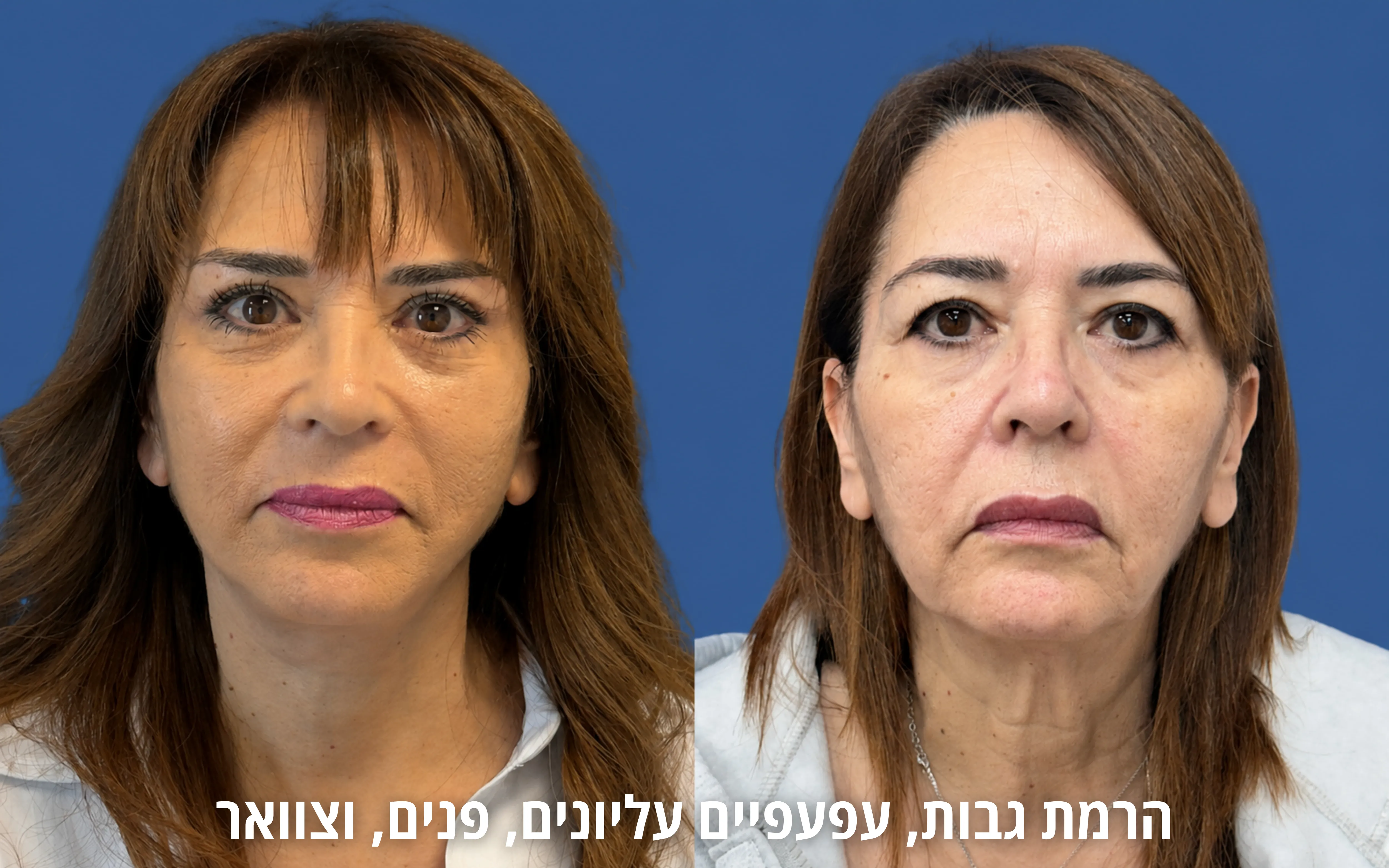 ניתוחי פנים לפני ואחרי אצל ד״ר דוד טל