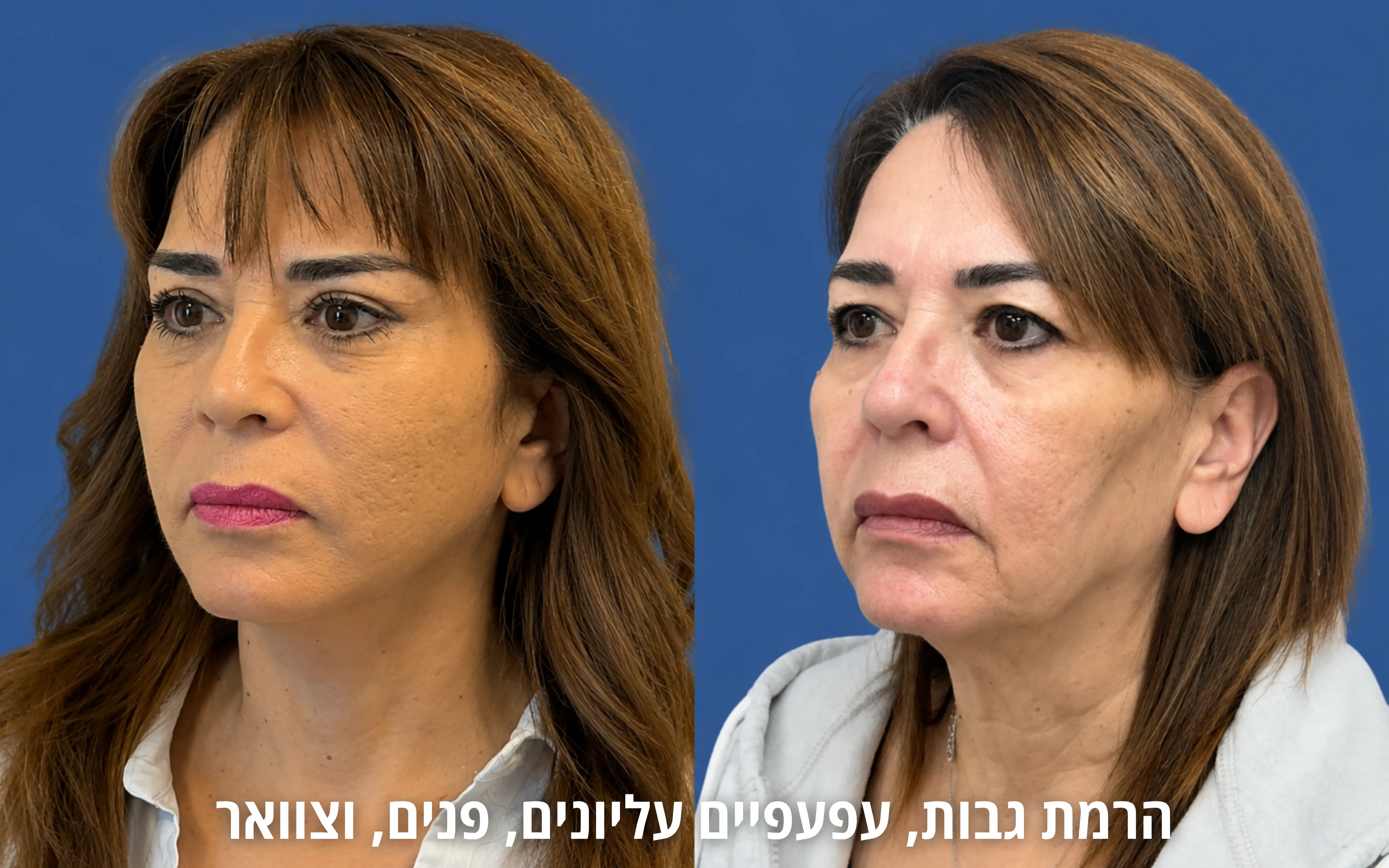 ניתוחי פנים לפני ואחרי אצל ד״ר דוד טל