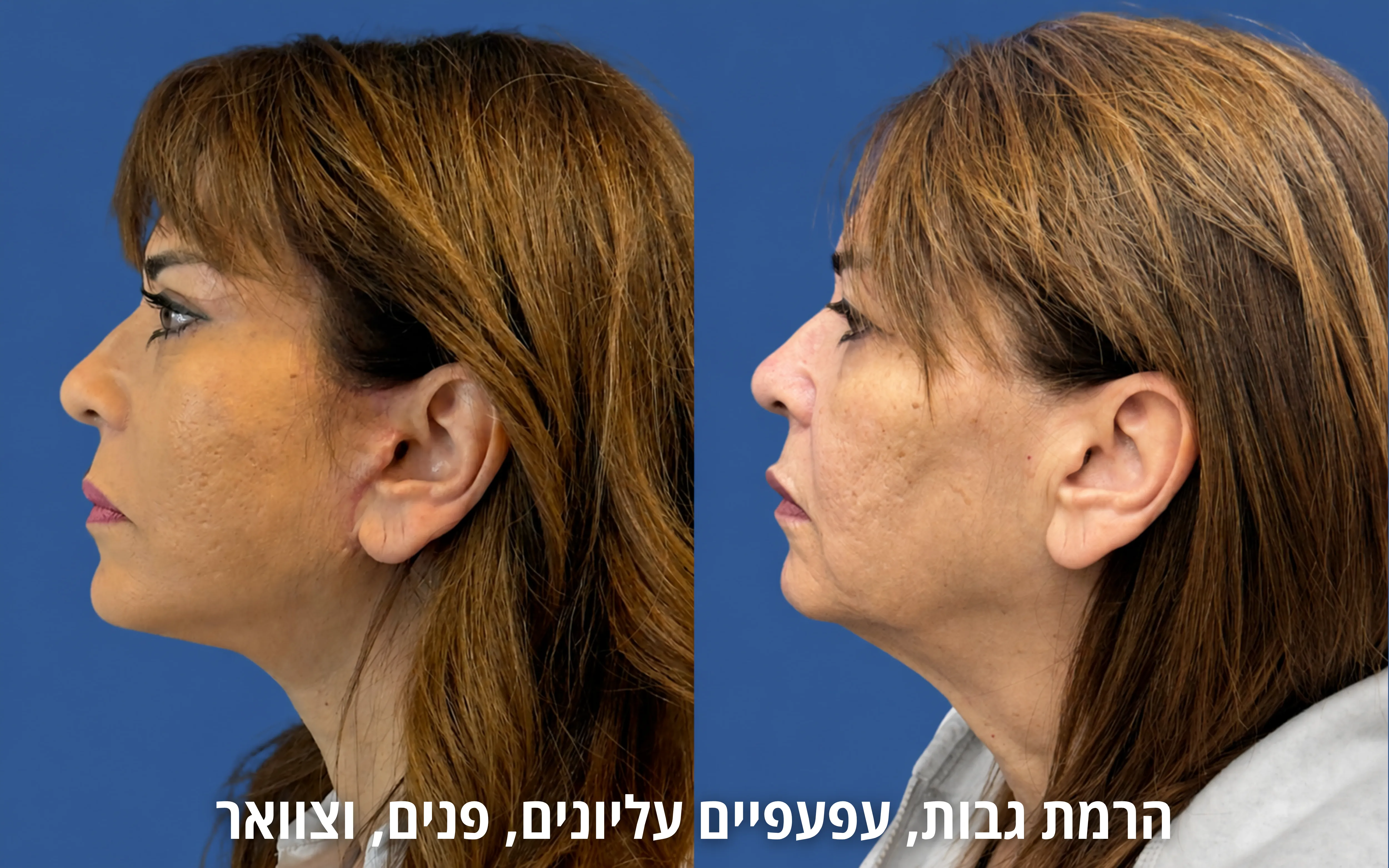 ניתוחי פנים לפני ואחרי אצל ד״ר דוד טל
