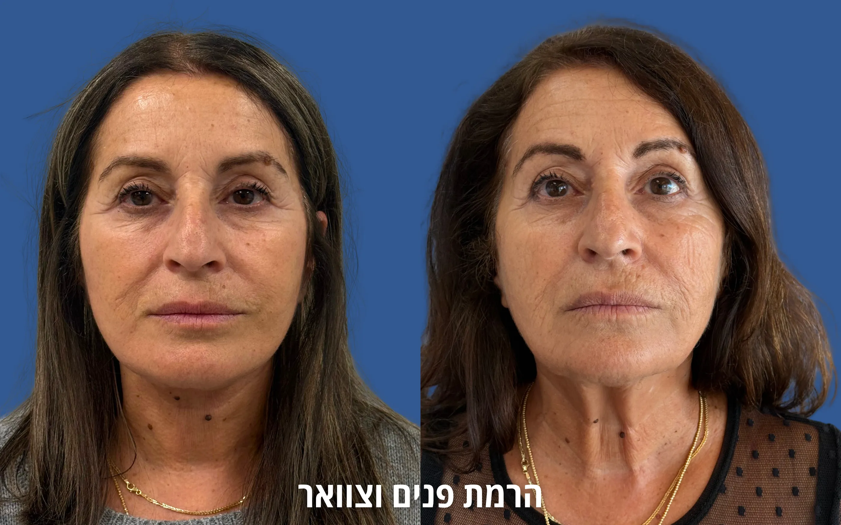 תוצאה טבעית לאחר ניתוח פנים לפני ואחרי