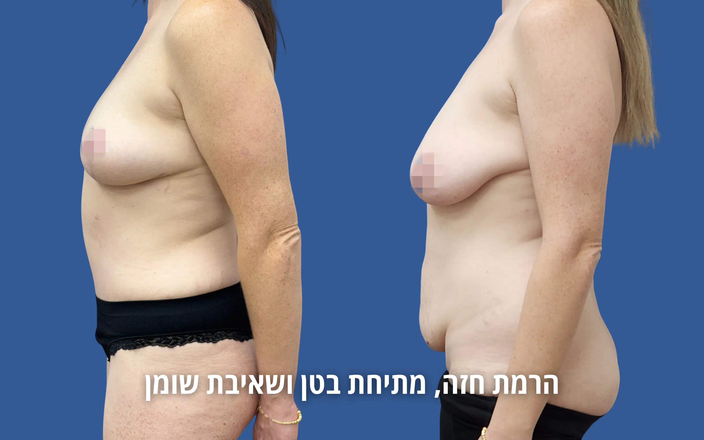 גלריית ניתוחי גוף לפני ואחרי אצל ד״ר דוד טל
