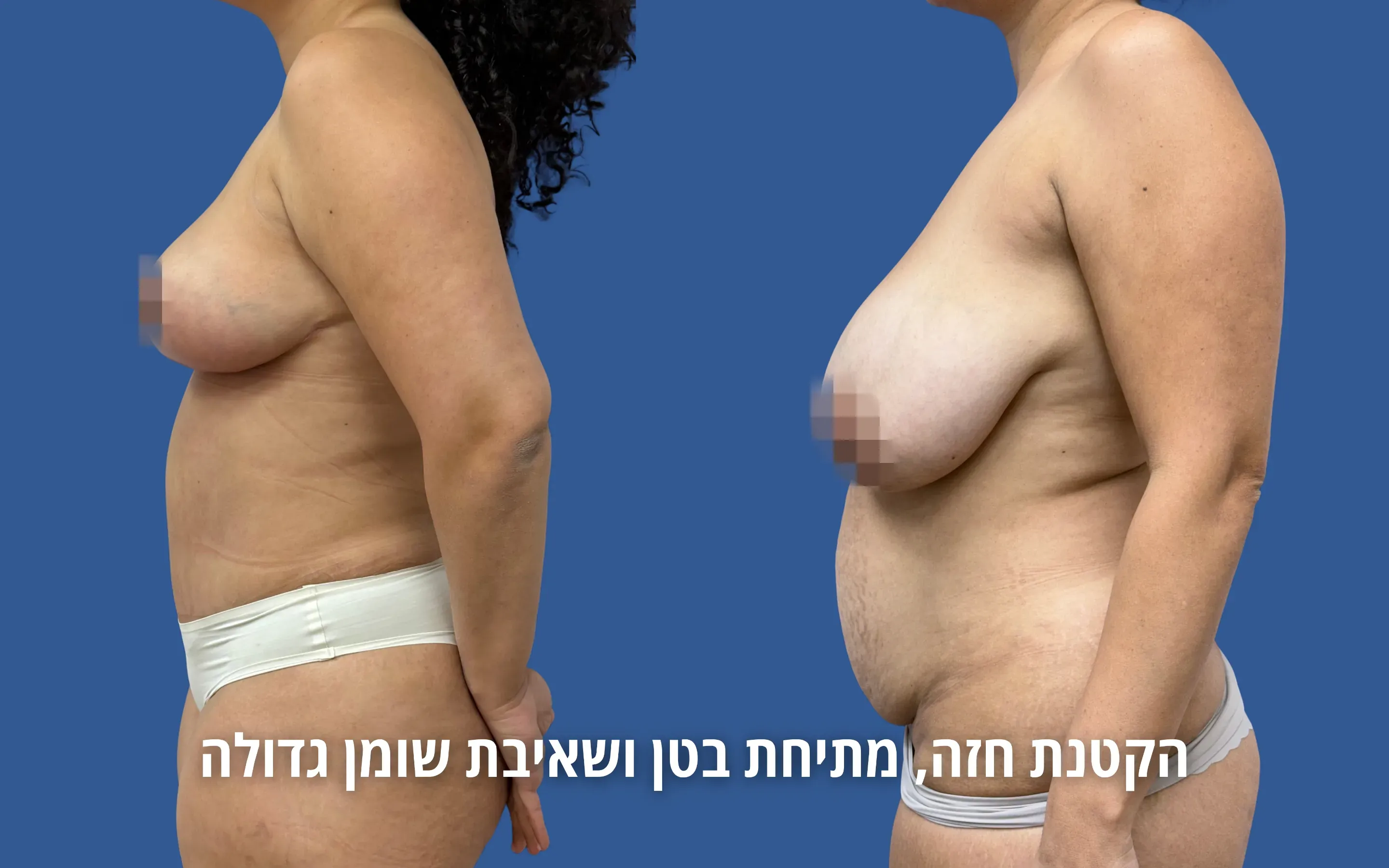 גלריית ניתוחי גוף לפני ואחרי אצל ד״ר דוד טל