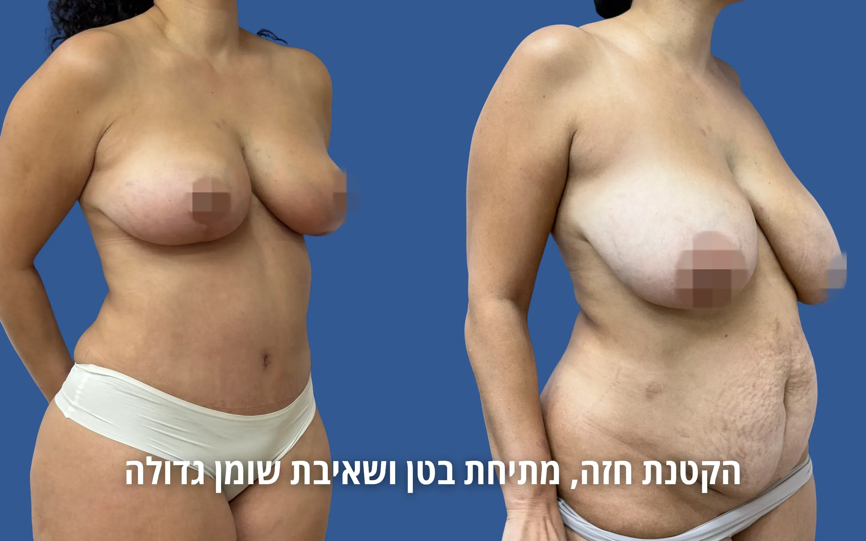 גלריית ניתוחי גוף לפני ואחרי אצל ד״ר דוד טל