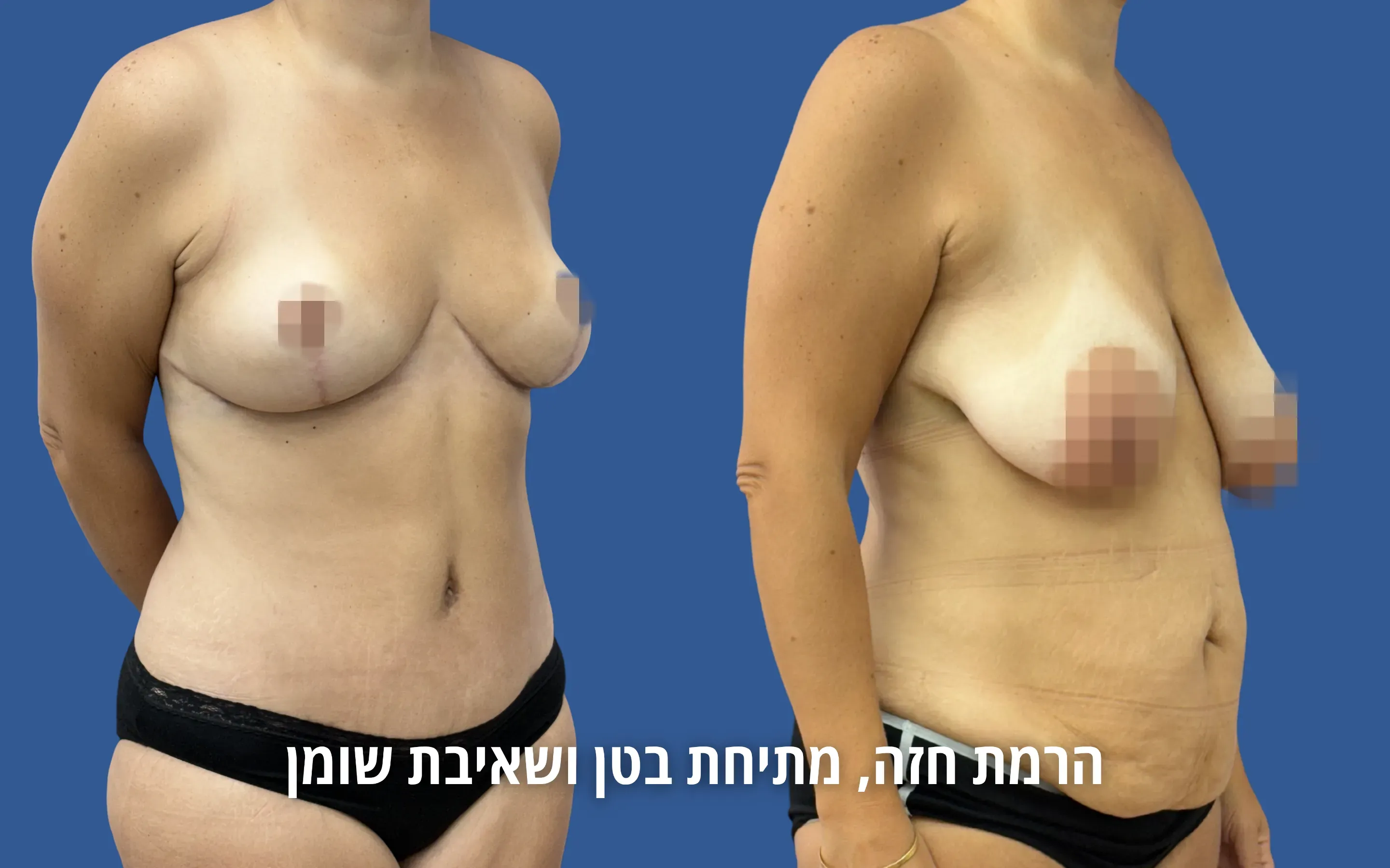 גלריית ניתוחי גוף לפני ואחרי אצל ד״ר דוד טל