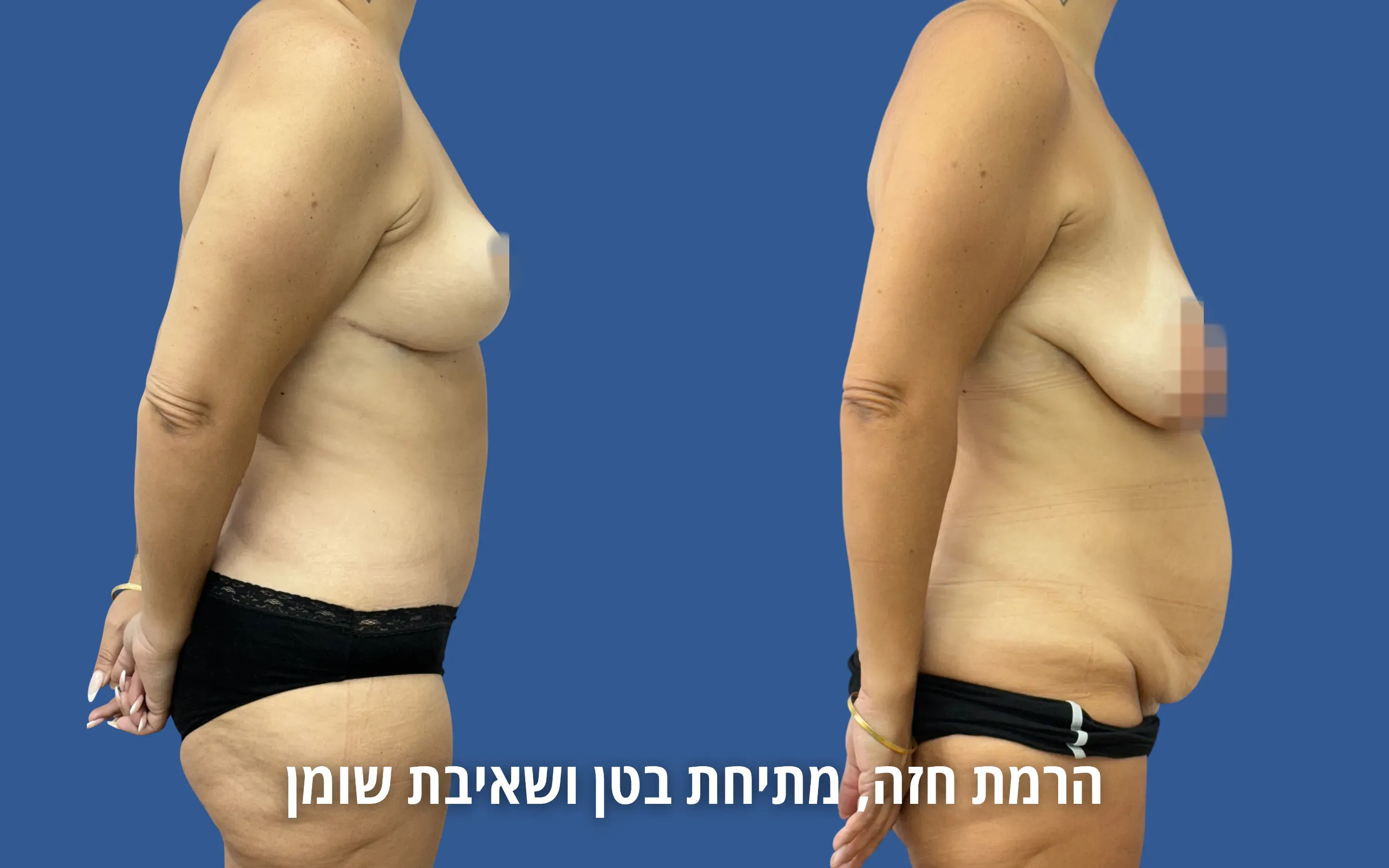 גלריית ניתוחי גוף לפני ואחרי אצל ד״ר דוד טל