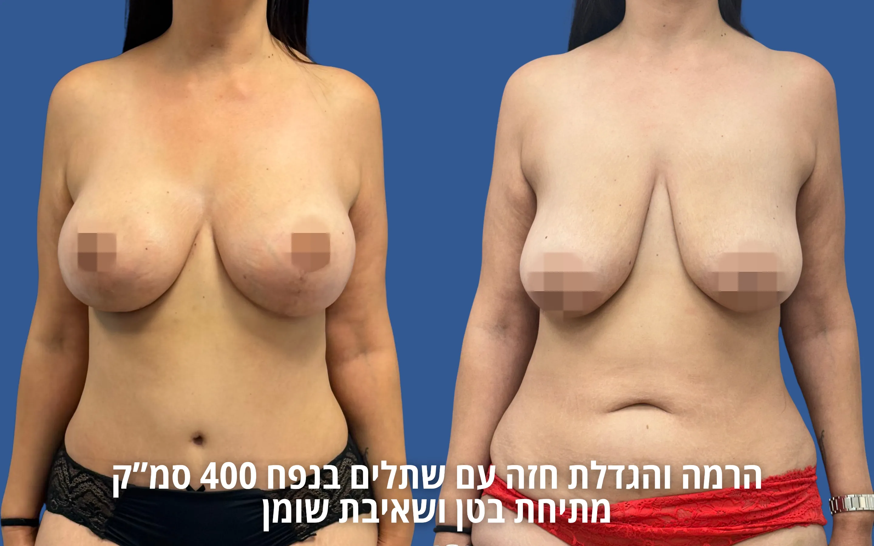 גלריית ניתוחי גוף לפני ואחרי אצל ד״ר דוד טל