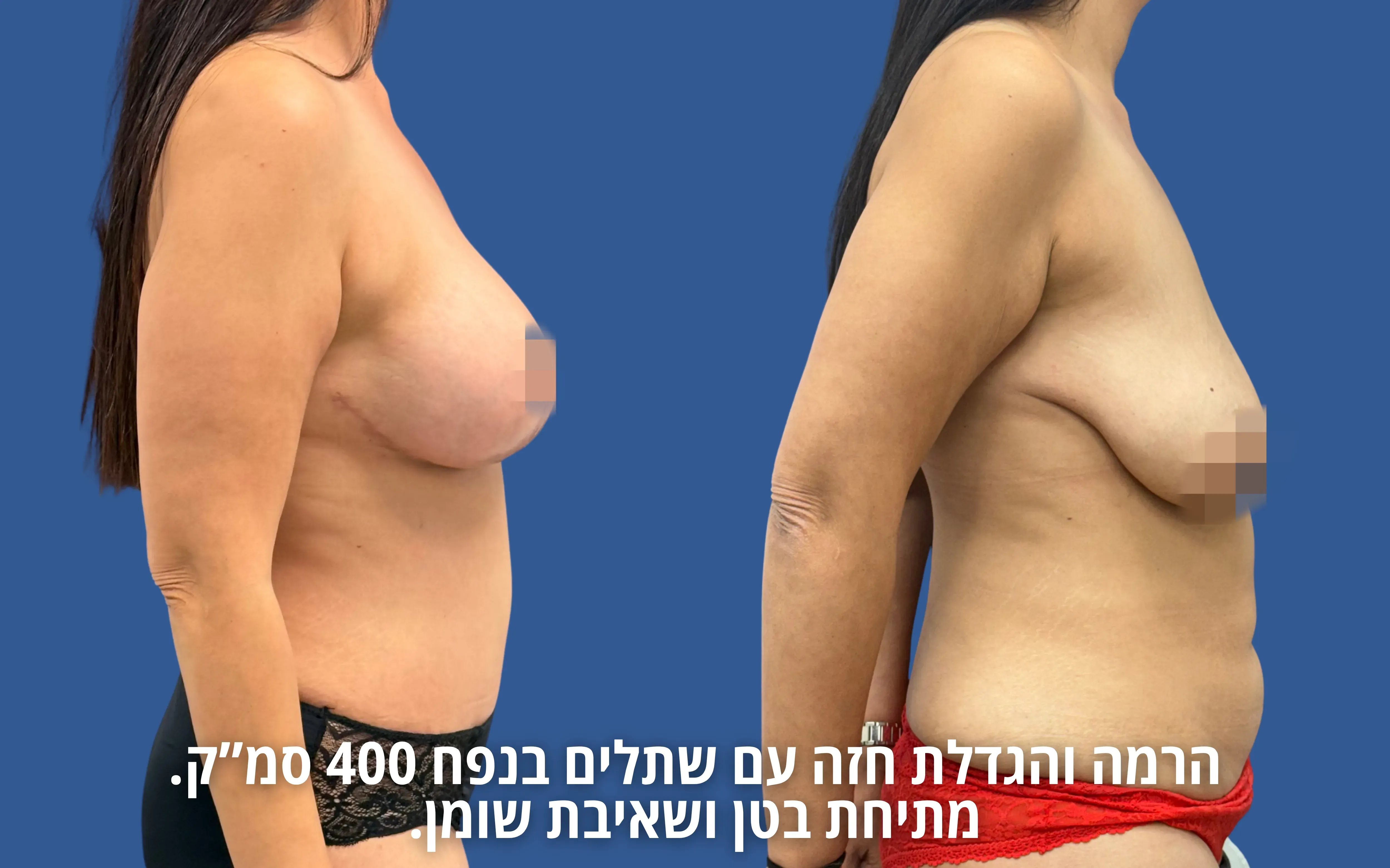 גלריית ניתוחי גוף לפני ואחרי אצל ד״ר דוד טל