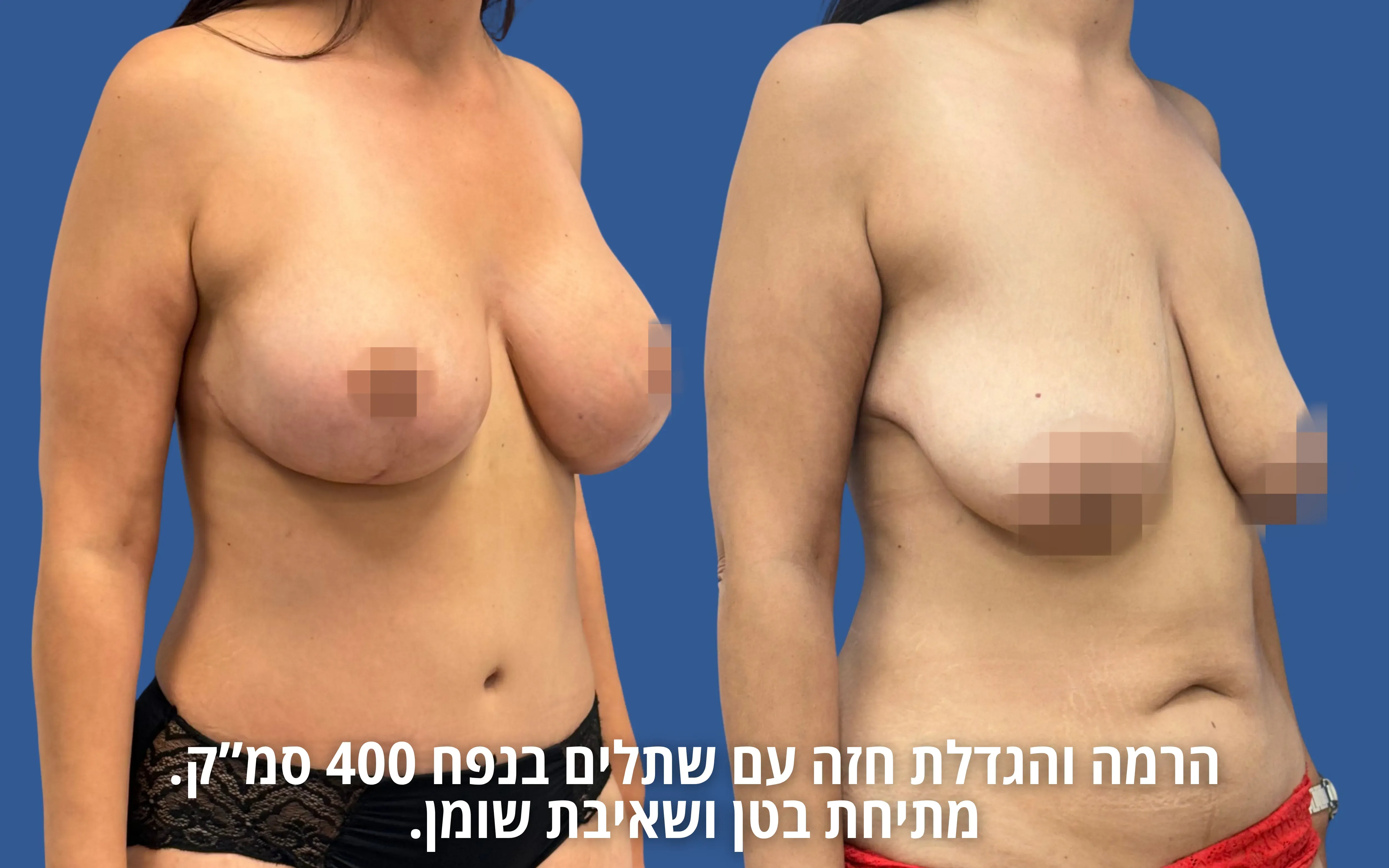 גלריית ניתוחי גוף לפני ואחרי אצל ד״ר דוד טל