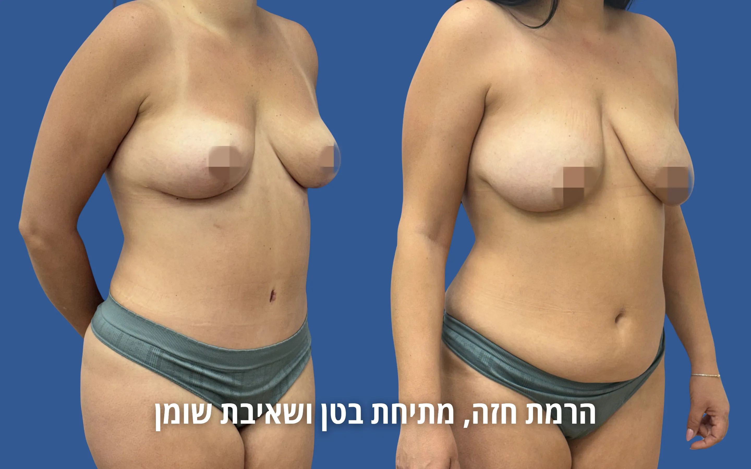 גלריית ניתוחי גוף לפני ואחרי אצל ד״ר דוד טל